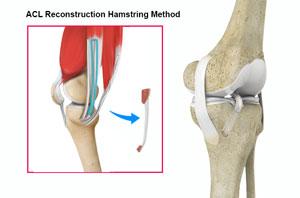 ACL Reconstruction Hamstring Tendon