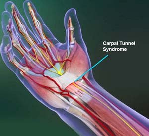 Cubital Tunnel Syndrome