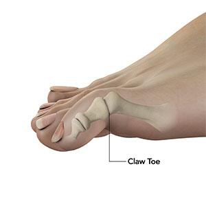 PCommon Toe Deformities