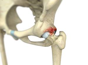 Femoroacetabular Impingement (FAI)