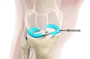 Meniscus Surgery