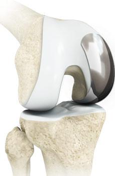 Unicondylar Knee Replacement