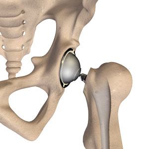 Hip Arthroplasty